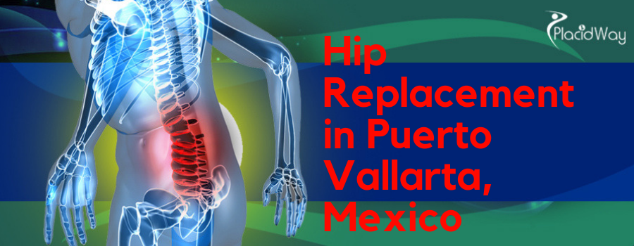 Hip Replacement in Puerto Vallarta, Mexico